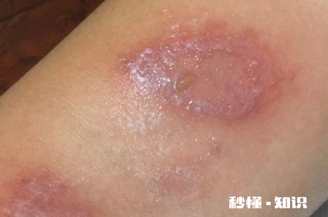 怎么判断是不是被隐翅虫咬了 隐形虫咬过皮肤症状图片