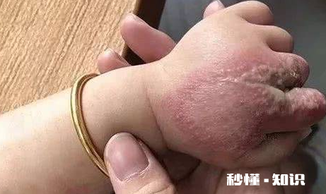 怎么判断是不是被隐翅虫咬了 隐形虫咬过皮肤症状图片