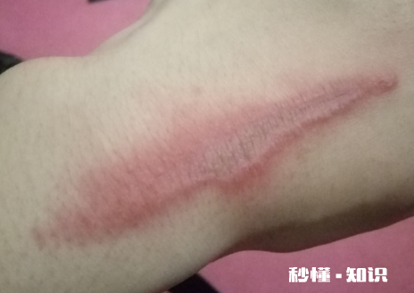 怎么判断是不是被隐翅虫咬了 隐形虫咬过皮肤症状图片