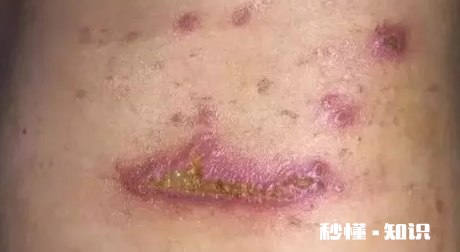 怎么判断是不是被隐翅虫咬了 隐形虫咬过皮肤症状图片