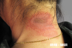 怎么判断是不是被隐翅虫咬了 隐形虫咬过皮肤症状图片