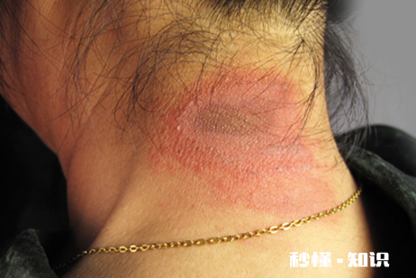 怎么判断是不是被隐翅虫咬了 隐形虫咬过皮肤症状图片