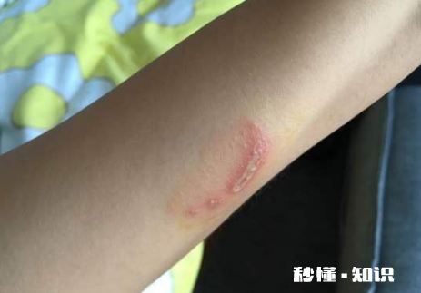 怎么判断是不是被隐翅虫咬了 隐形虫咬过皮肤症状图片