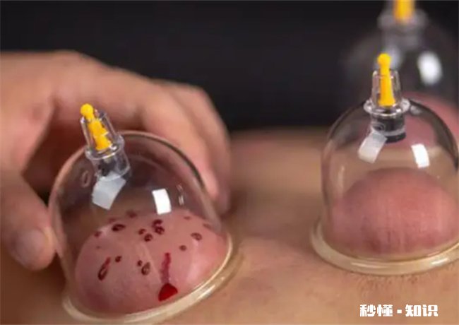 经期能不能拔火罐 经期能不能拔火罐刮痧