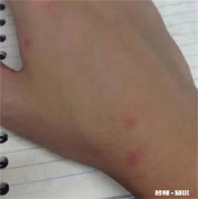 被蚊子咬了会不会留疤 被蚊子咬了会留疤吗