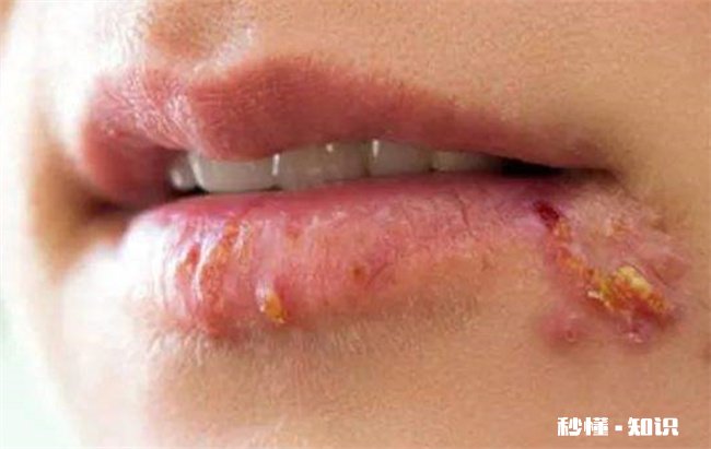 嘴上的疱疹会传染身体其他部位吗 嘴巴里的疱疹会传染吗