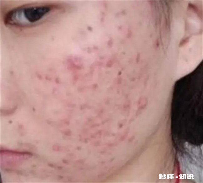 脸上长痘痘如何消除 男生脸上长痘痘如何消除