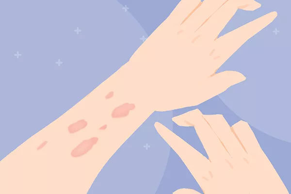 荨麻疹不能吃什么食物有哪些 荨麻疹的饮食禁忌