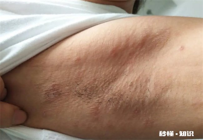 腋下起皮屑是怎么回事 腋下很痒起皮屑发黑怎么回事