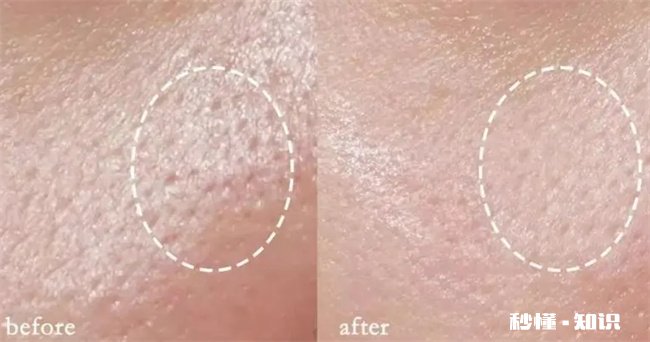 停止熬夜毛孔会变小吗 熬夜会增大毛孔吗