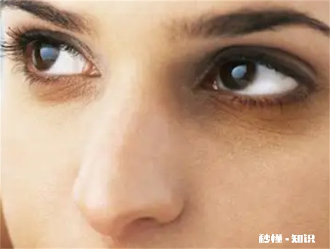黑眼圈很重怎么去除 黑眼圈如何去掉