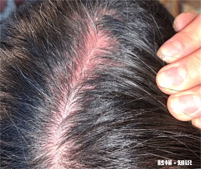 爽身粉擦头发有危害吗 爽身粉擦头发可以去油吗