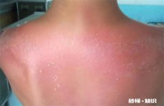 晒伤后皮肤发红几天能好