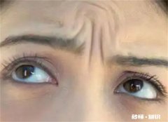 从小就有抬头纹怎么办