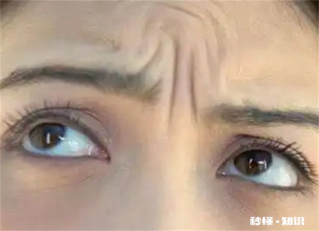 从小就有抬头纹怎么办