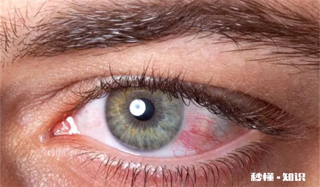 戴美瞳角膜受损还可以复原吗