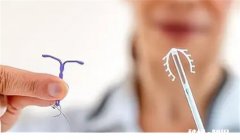 取环时疼吗有30年了