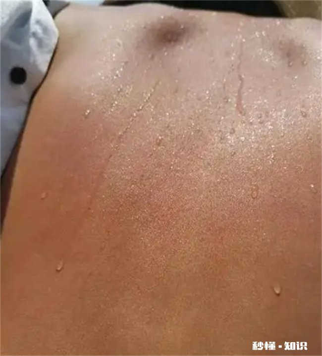 三伏天晒背后的排病反应