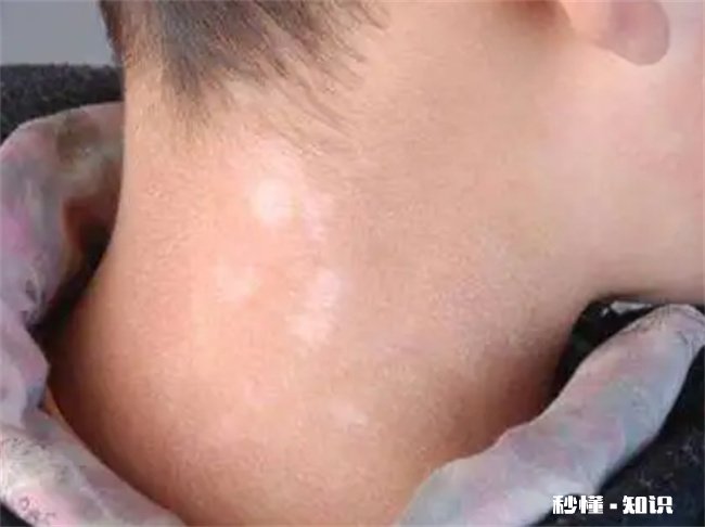 突然长出白斑是什么原因