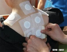 三伏贴一定要贴五次吗