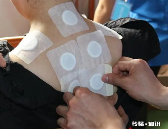 三伏贴一定要贴五次吗