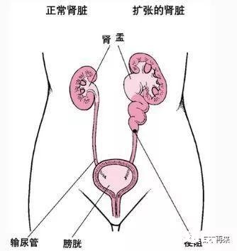 肾里面为什么会有结石