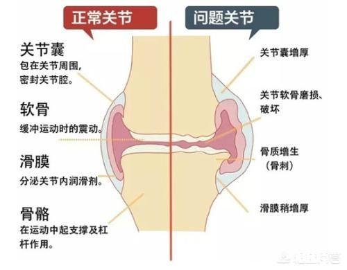 膝盖积液得了滑膜炎后适合什么运动