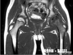 髋关节结核是什么病是由什么引起的