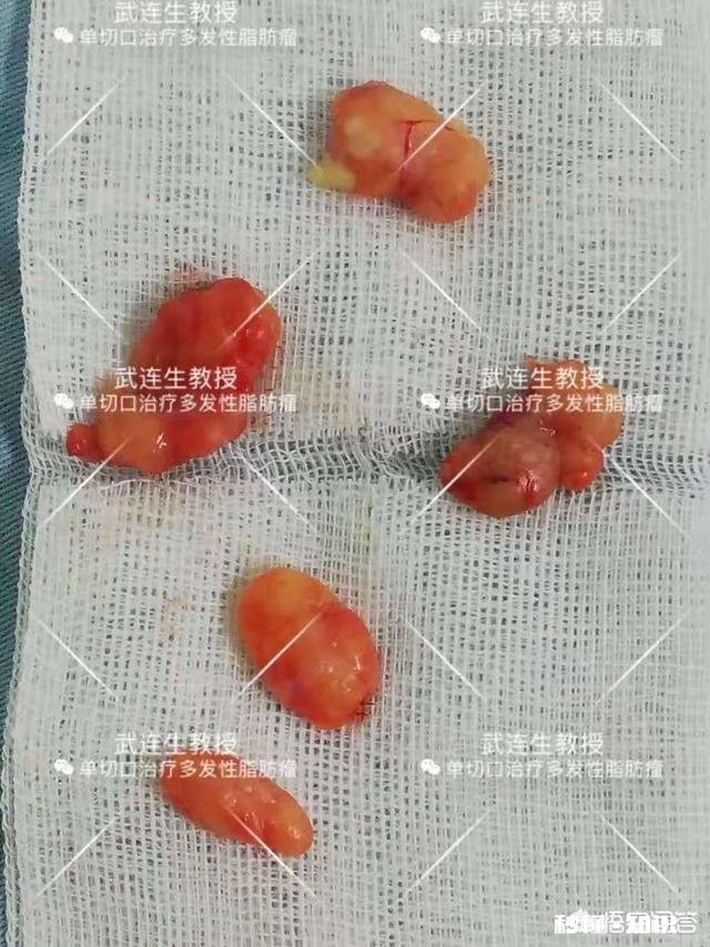 脂肪瘤能治愈吗