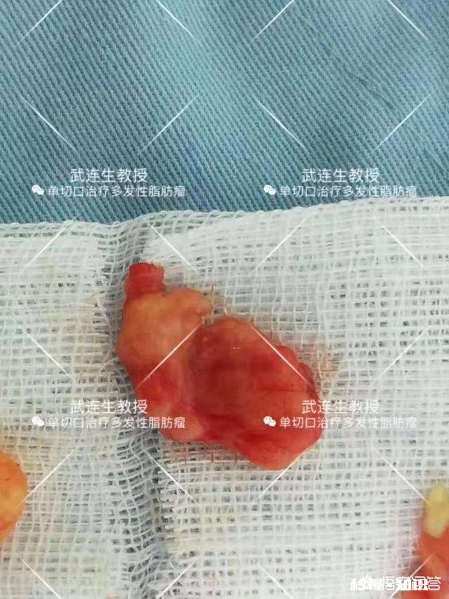 脂肪瘤能治愈吗