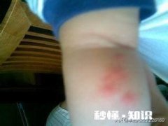 宝宝四个月被蚊子咬了不用药有什么办法