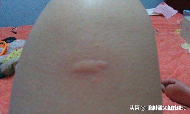 宝宝四个月被蚊子咬了不用药有什么办法