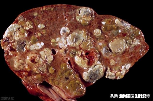 每年有多少人死于肝癌,肝不好身体会有什么反应