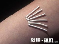 夫妻是一方结扎好，还是做好避孕措施好