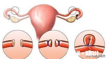 夫妻是一方结扎好，还是做好避孕措施好