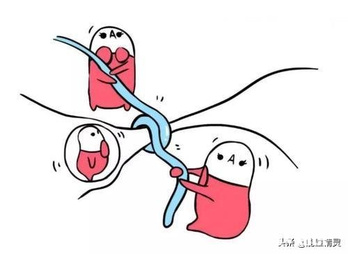 夫妻是一方结扎好，还是做好避孕措施好