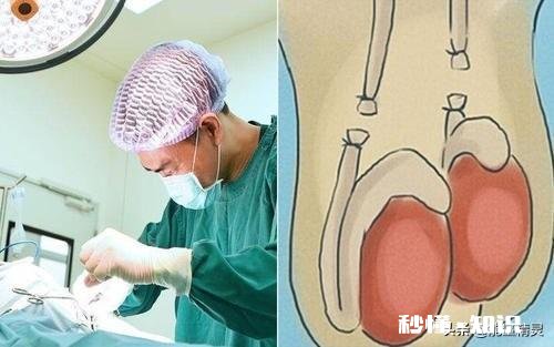 夫妻是一方结扎好，还是做好避孕措施好