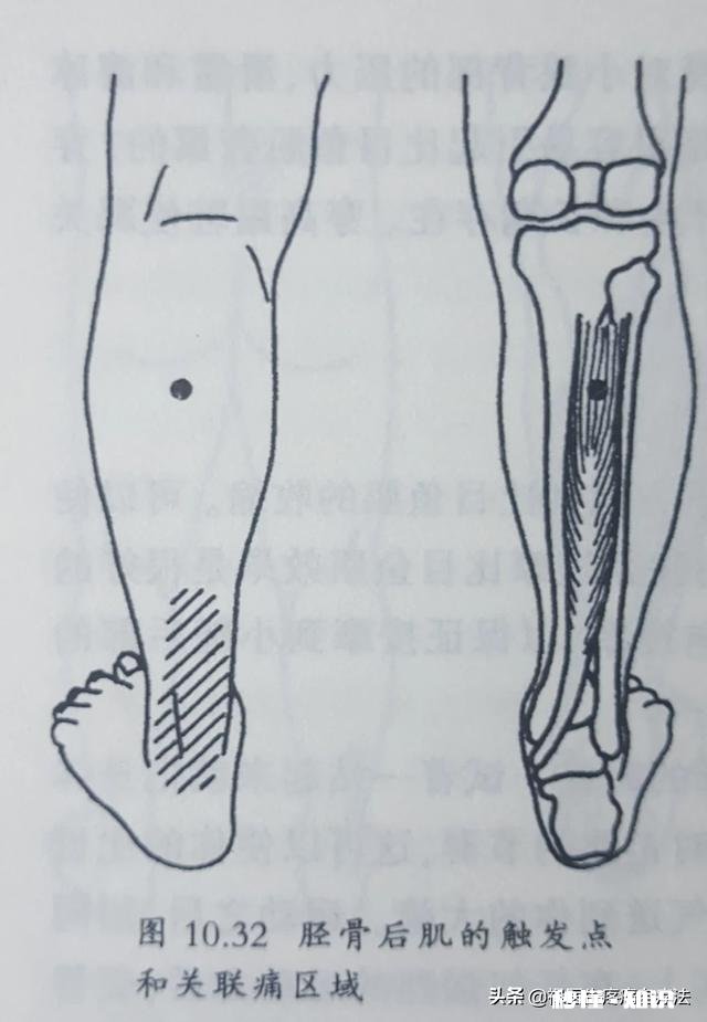 早晨落地第一脚疼痛难忍，医生查出跟骨骨刺，患者将来还能走路吗