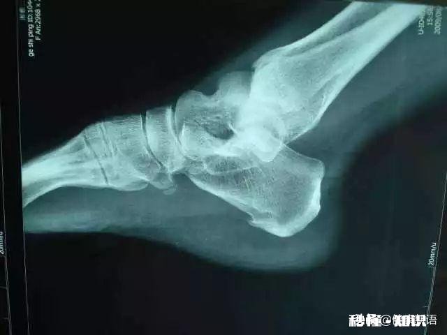 早晨落地第一脚疼痛难忍，医生查出跟骨骨刺，患者将来还能走路吗