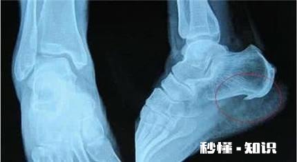 早晨落地第一脚疼痛难忍，医生查出跟骨骨刺，患者将来还能走路吗