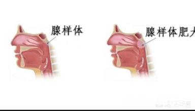 孩子睡觉呼吸声比较重,有时候还打呼,这样正常吗
