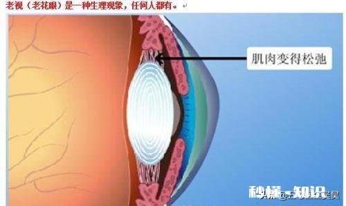 老年人有白内障可以带近视眼镜和老花镜吗