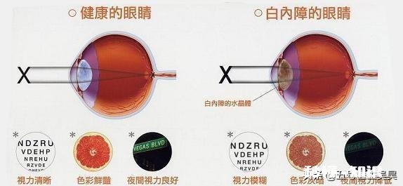 老年人有白内障可以带近视眼镜和老花镜吗