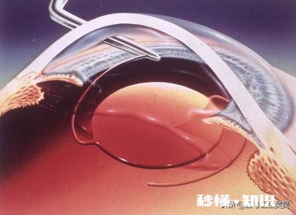 老年人有白内障可以带近视眼镜和老花镜吗