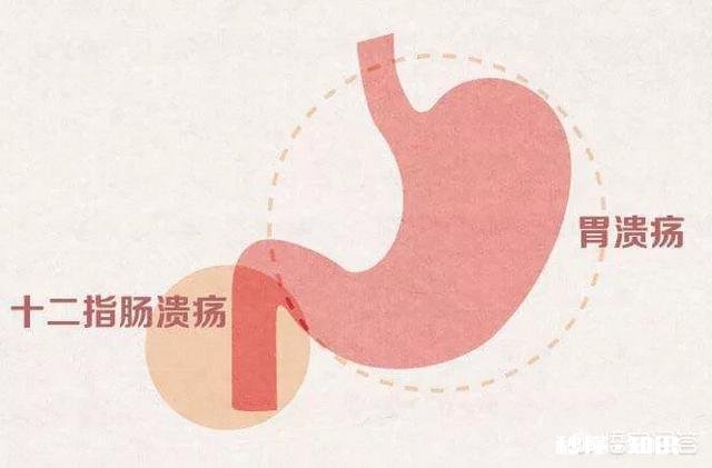 上腹痛一定是胃溃疡吗如何区分十二指肠溃疡和胃溃疡