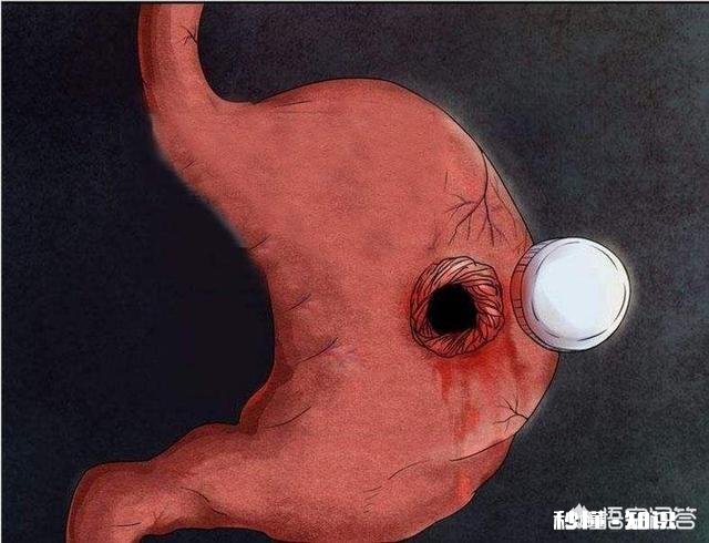 上腹痛一定是胃溃疡吗如何区分十二指肠溃疡和胃溃疡