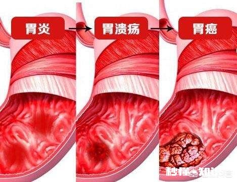 上腹痛一定是胃溃疡吗如何区分十二指肠溃疡和胃溃疡