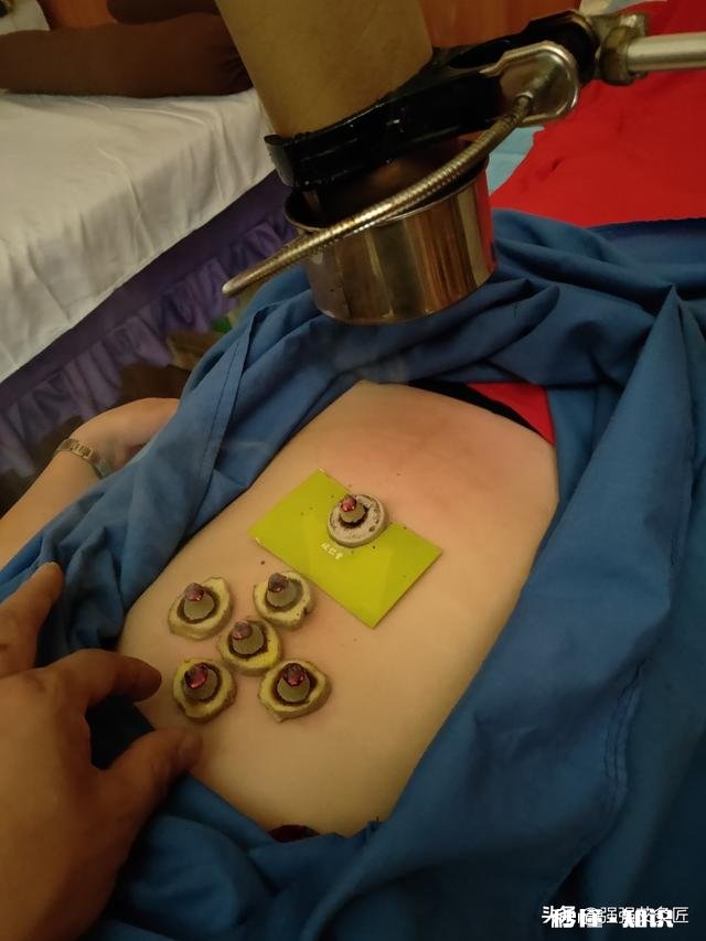 艾灸完后背为什么会痒