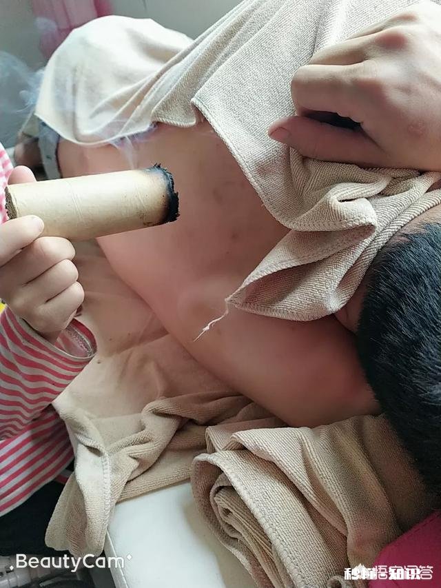 艾灸完后背为什么会痒