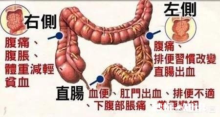 晨起哪种大便预示癌